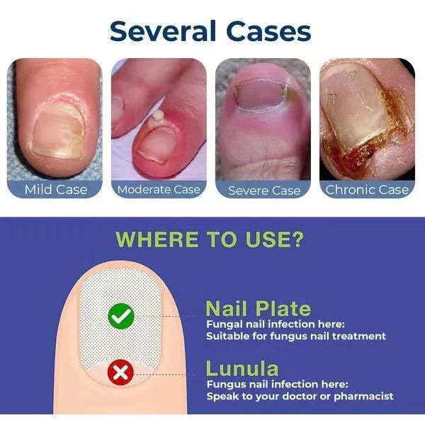 Anti Paronychia Relief Oil Buy 1 Get 1 Free