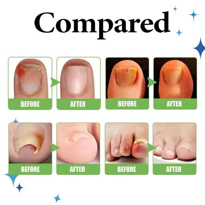 Anti Paronychia Relief Oil Buy 1 Get 1 Free