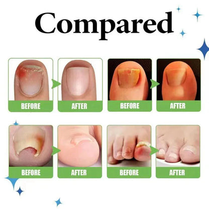 Anti Paronychia Relief Oil Buy 1 Get 1 Free